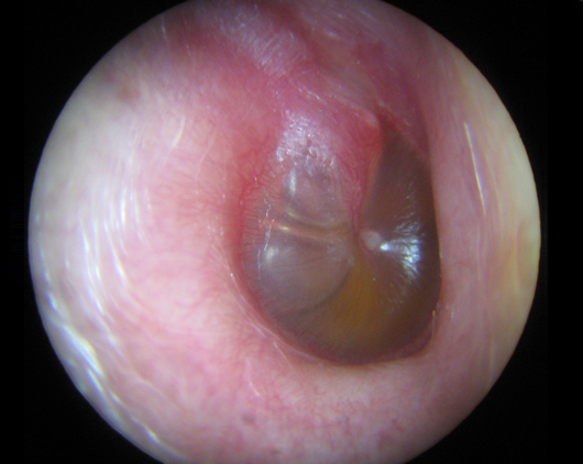 Inside close up view of a swollen and inflamed infected eardrum